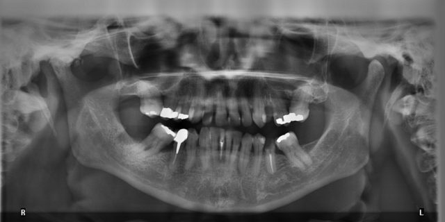 Les désordres temporo-mandibulaires